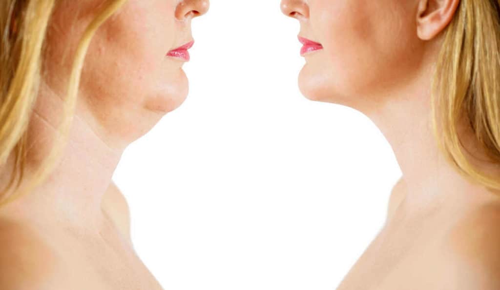 Double Chin treatment Walthamstow before and after results
