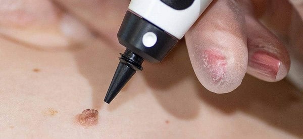 After Skin Tag Removal Walthamstow