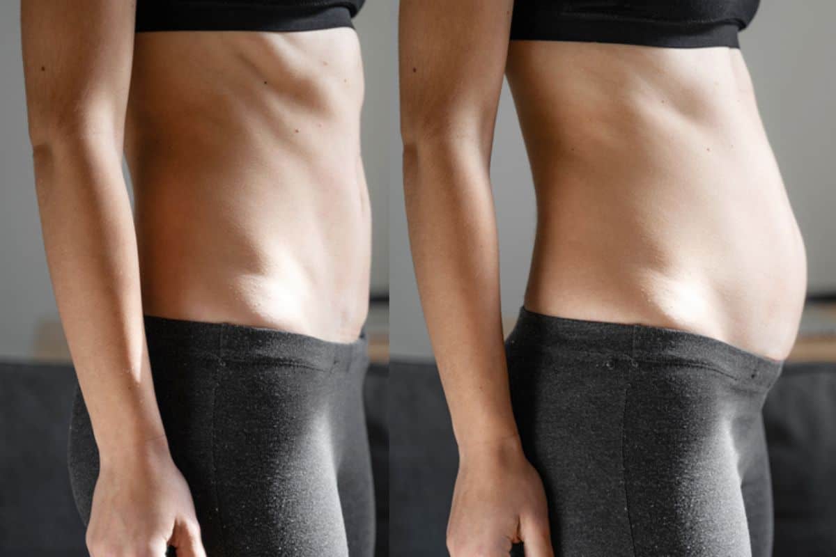 How long does diastasis recti take to improve Walthamstow?
