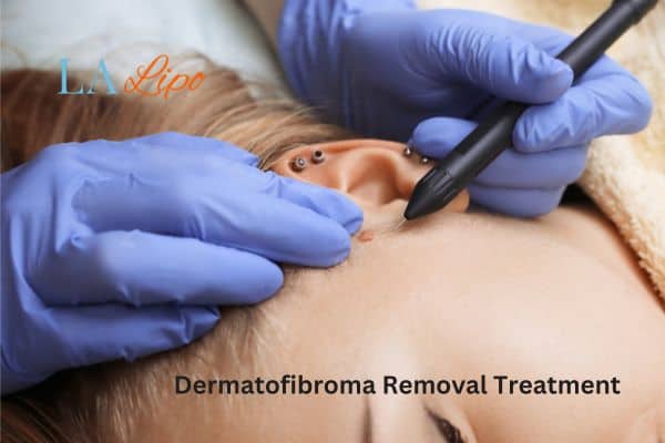 Dermatofibroma Removal Treatment Walthamstow