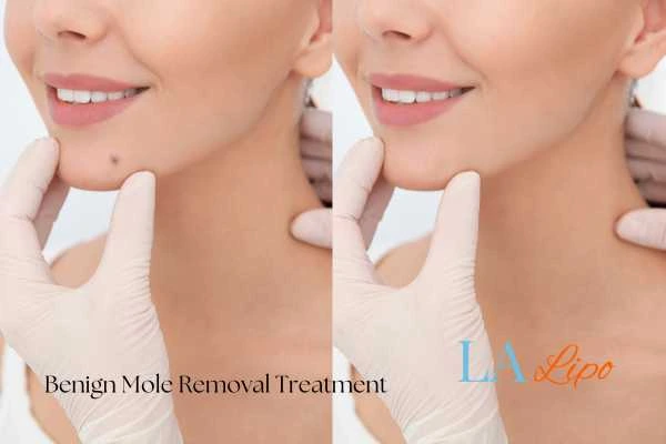 Before-and-after results following benign mole-removal treatment Walthamstow
