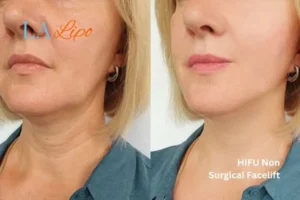 hi-fu for wrinkles Walthamstow before and after results