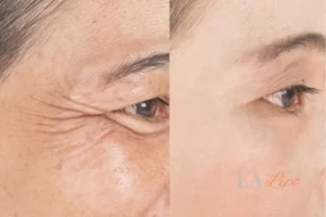 Before and after results of woman - HI-fu wrinkles reduction treatment Walthamstow