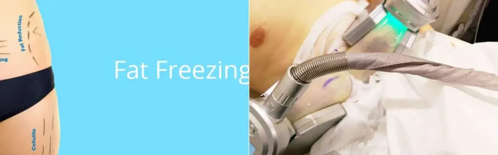 Fat freezing Walthamstow on multiple areas of the body