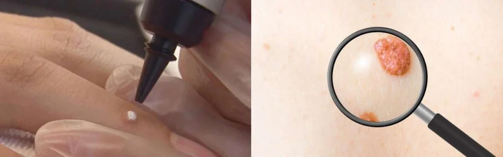 CryoPen practitioner Walthamstow assessing a benign mole before treatment