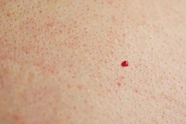 close up of a cherry angioma Walthamstow