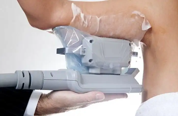 Picture of fat freezing Walthamstow on the upper arms.