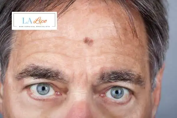 Solar Lentigo Removal Walthamstow image of man with mark on his forehead