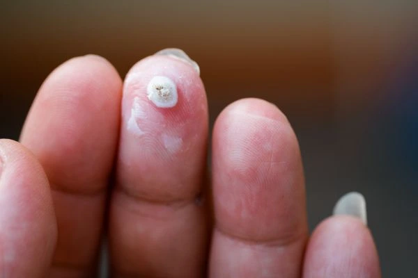 wart on person finger - cryotherapy to treat from LA LIPO Walthamstow