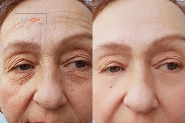 The powerful benefits of Morpheus8 Treatment Walthamstow - Call Our team today!