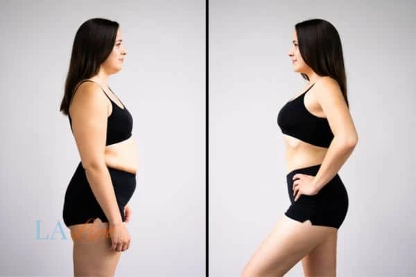 Picture of womans before and after using LA-EMS body sculpting to improve her core strength Walthamstow