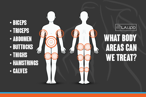 Diagram to show areas you can have LA-EMS Body Sculpting Treatment Walthamstow
