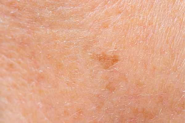 close up picture of age spots Walthamstow