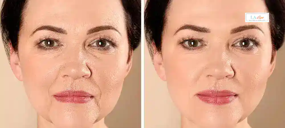 How Long Does It Take to See Results and How Long Do They Last Walthamstow?